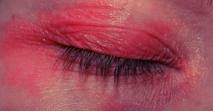 mites-are-pooping-on-your-eyes-as-you-sleep